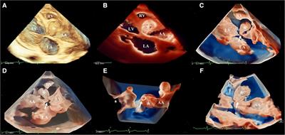 Frontiers Case Report Novel Three Dimensional Echocardiographic